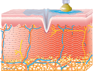 Collagen Synthesis Begins | TempSure Envi