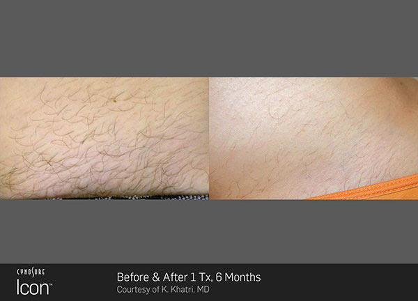 Laser Hair Removal Eastern Carolina Aesthetics Wilson NC